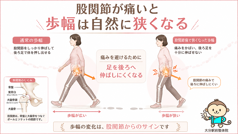 股関節が痛いと歩幅が狭くなる理由を、通常の歩幅と股関節痛で狭くなった歩幅の比較で解説した図解画像です。股関節伸展の制限や、痛みを避ける歩き方により、足を後ろへ伸ばしにくくなる仕組みを視覚的に伝えています。 股関節が痛いと歩幅が狭くなる理由を、通常の歩幅と股関節痛で狭くなった歩幅の比較で解説した図解画像です。股関節伸展の制限や、痛みを避ける歩き方により、足を後ろへ伸ばしにくくなる仕組みを視覚的に伝えています。