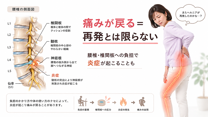 腰椎椎間板ヘルニアの痛みを繰り返す方に向けて、再発だけでなく腰椎や椎間板への負担、神経根周囲の炎症によって痛みが戻る可能性を解説した医療図解です。腰からお尻、足にかけて違和感が出る理由を、腰椎・椎間板・神経根の関係からわかりやすく示しています。 腰椎椎間板ヘルニアの痛みを繰り返す方に向けて、再発だけでなく腰椎や椎間板への負担、神経根周囲の炎症によって痛みが戻る可能性を解説した医療図解です。腰からお尻、足にかけて違和感が出る理由を、腰椎・椎間板・神経根の関係からわかりやすく示しています。