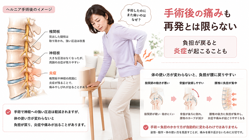 ヘルニア手術後でも、体の使い方や姿勢が変わらないと腰椎や椎間板周囲に負担が戻り、炎症や痛みが出ることを説明した医療整体図解です。手術後の痛みをすぐ再発と決めつけず、腰への負担のかかり方を見直す重要性を伝えています。 ヘルニア手術後でも、体の使い方や姿勢が変わらないと腰椎や椎間板周囲に負担が戻り、炎症や痛みが出ることを説明した医療整体図解です。手術後の痛みをすぐ再発と決めつけず、腰への負担のかかり方を見直す重要性を伝えています。