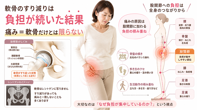 股関節の軟骨のすり減りを、痛みの直接原因と決めつけず、骨盤の傾きや歩き方のクセによって股関節へ負担が集中する流れを解説した医療図解画像です。股関節の構造やレントゲン風イラストを用い、軟骨のすり減りは負担が続いた結果の一つであることを分かりやすく示しています。 股関節の軟骨のすり減りを、痛みの直接原因と決めつけず、骨盤の傾きや歩き方のクセによって股関節へ負担が集中する流れを解説した医療図解画像です。股関節の構造やレントゲン風イラストを用い、軟骨のすり減りは負担が続いた結果の一つであることを分かりやすく示しています。