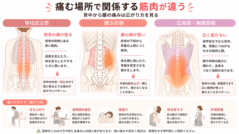 背中から腰にかけて痛みが出る主な筋肉のパターンを比較した医学図解画像です。脊柱起立筋、腰方形筋、広背筋・胸腰筋膜の位置と、それぞれ痛みや重だるさが出やすい範囲を示しています。立ち上がり、長時間座位、寝返り、体を反らす動作などで痛みが出る理由を理解しやすい構成です。