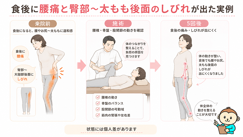 食後に腰痛と臀部から太もも後面のしびれが出ていた方の実例を、来院前・施術・5回後の流れで紹介した画像です。腰椎・骨盤・股関節の動きを整えることで、食後の痛みやしびれが出にくくなった経過を分かりやすく示しています。 食後に腰痛と臀部から太もも後面のしびれが出ていた方の実例を、来院前・施術・5回後の流れで紹介した画像です。腰椎・骨盤・股関節の動きを整えることで、食後の痛みやしびれが出にくくなった経過を分かりやすく示しています。