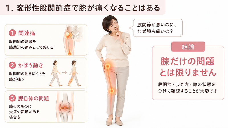 変形性股関節症がある方に膝痛が起こる主な仕組みを、人物と3つの図解で整理した画像です。股関節から太もも、膝へ痛みを感じる関連痛、股関節の動きにくさを膝が補うかばう動作、膝そのものに炎症や変形があるケースを分けて示しています。変形性股関節症があって膝も痛む場合でも、膝だけの問題とは限らず、股関節の状態や歩き方、膝自体の状態をそれぞれ確認することが大切だと伝える内容です。 変形性股関節症がある方に膝痛が起こる主な仕組みを、人物と3つの図解で整理した画像です。股関節から太もも、膝へ痛みを感じる関連痛、股関節の動きにくさを膝が補うかばう動作、膝そのものに炎症や変形があるケースを分けて示しています。変形性股関節症があって膝も痛む場合でも、膝だけの問題とは限らず、股関節の状態や歩き方、膝自体の状態をそれぞれ確認することが大切だと伝える内容です。