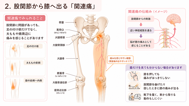 股関節から生じた刺激を、太ももや膝周辺の痛みとして感じる「関連痛」の仕組みを解説した医療図解です。中央に骨盤、股関節、大腿骨、膝関節を配置し、股関節から太ももの前側・内側を通って膝へ痛みを感じやすい範囲を示しています。股関節と膝の感覚が近い神経経路を通ることで、脳が股関節からの刺激を膝の痛みとして認識する場合があります。膝を押しても痛む場所がはっきりしない場合や、股関節を曲げたり回したりした際に膝まで痛む場合は、股関節の状態も確認する必要があります。 股関節から生じた刺激を、太ももや膝周辺の痛みとして感じる「関連痛」の仕組みを解説した医療図解です。中央に骨盤、股関節、大腿骨、膝関節を配置し、股関節から太ももの前側・内側を通って膝へ痛みを感じやすい範囲を示しています。股関節と膝の感覚が近い神経経路を通ることで、脳が股関節からの刺激を膝の痛みとして認識する場合があります。膝を押しても痛む場所がはっきりしない場合や、股関節を曲げたり回したりした際に膝まで痛む場合は、股関節の状態も確認する必要があります。