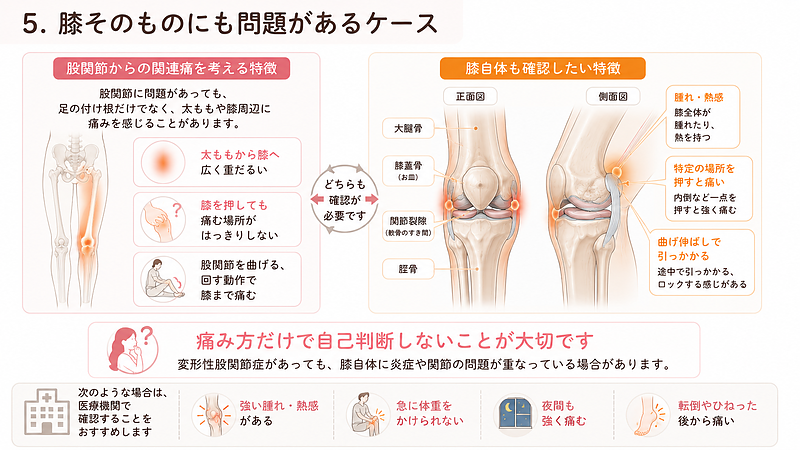 変形性股関節症に伴う関連痛と、膝そのものに炎症や関節の問題があるケースの特徴を比較した画像です。股関節由来の関連痛では、太ももから膝へ広く重だるさを感じる、膝を押しても痛む場所がはっきりしない、股関節を曲げたり回したりすると膝まで痛むといった特徴がみられることがあります。一方、膝全体の腫れや熱感、特定の場所を押した際の強い痛み、曲げ伸ばしでの引っかかりなどがある場合は、膝自体の状態も確認する必要があります。 変形性股関節症に伴う関連痛と、膝そのものに炎症や関節の問題があるケースの特徴を比較した画像です。股関節由来の関連痛では、太ももから膝へ広く重だるさを感じる、膝を押しても痛む場所がはっきりしない、股関節を曲げたり回したりすると膝まで痛むといった特徴がみられることがあります。一方、膝全体の腫れや熱感、特定の場所を押した際の強い痛み、曲げ伸ばしでの引っかかりなどがある場合は、膝自体の状態も確認する必要があります。