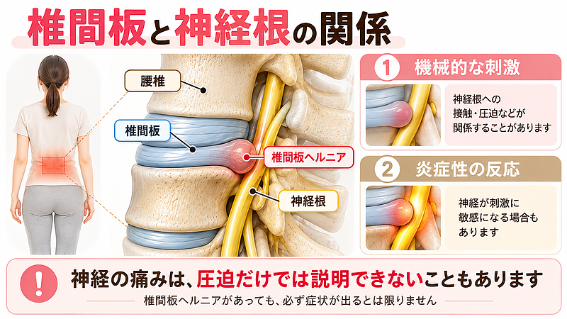 腰椎椎間板ヘルニアでは、突出した椎間板による神経根への刺激や炎症性の反応が、お尻や足の痛み・しびれに関係する場合があります。ただし、椎間板ヘルニアがあっても必ず症状が現れるわけではありません。