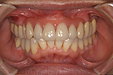 入れ歯で満足に噛めない方必読！    　   自由診療歴20年の歯科医が教える【噛める入れ歯の条件】とは？