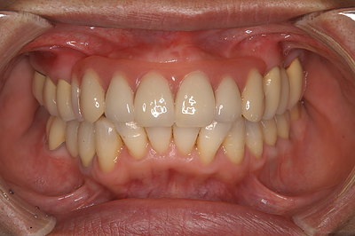 入れ歯で満足に噛めない方必読！    　   自由診療歴20年の歯科医が教える【噛める入れ歯の条件】とは？