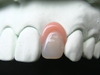 津谷歯科は快適な入れ歯作りを目指して今年で３４年経ちます。