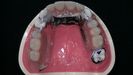 快適な入れ歯とは　患者さんの使い易い入れ歯は