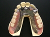 金属床義歯の大きなメリットは従来のプラスチックの入れ歯を超えます
