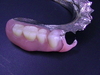 部分入れ歯に使われるクラスプについて