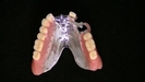 「カチッと入れ歯」の症例