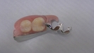 奥歯の遊離端1～2本欠損には「カチッと入れ歯」がお勧めです