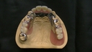 前歯＋奥歯の入れ歯には話やすい「カチッと入れ歯」金属床タイプ