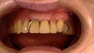 金属製のバネ　入れ歯の口もとなんとかなりませんか？