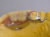 奥歯の1本から2本の欠損の入れ歯の気になる点
