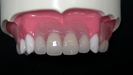 「カチッと入れ歯」の様々なメリット