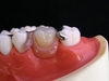 1～3本の中間歯欠損には「カチッと入れ歯」がお勧めです