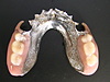 健康保険の入れ歯と自費診療の入れ歯の違いは？