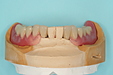 入れ歯で噛んで痛い方に特化した部分入れ歯とは？