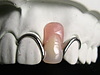 部分入れ歯と維持装置の関係とは