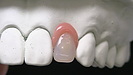 歯に優しい入れ歯「カチッと入れ歯」の仕組み