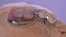 コンパクトで審美性が優れた「カチッと入れ歯」2～3歯欠損例