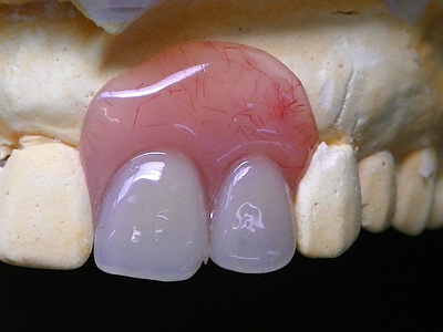入れ歯新調される時、入れ歯の口もとの相談をお受けします