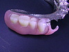 使いやすい部分入れ歯は金属床義歯に限ります