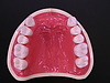 部分入れ歯には金属床義歯をお勧めします