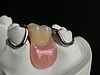 クラスプ部分入れ歯の問題点とは？