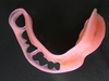 部分入れ歯の痛みには新しい「ノンクラスプタイプ　やわらかい入れ歯」をお勧めします