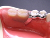 奥歯２本の入れ歯は「カチッと入れ歯」が最適です！