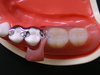 残った歯の動揺と部分入れ歯について