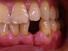 下顎前歯の「カチッと入れ歯」のケース