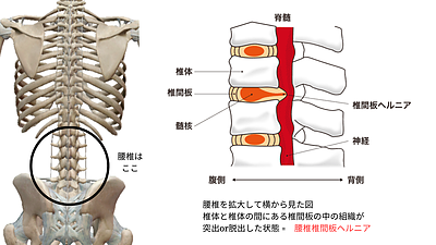 腰椎と腰椎椎間板ヘルニア