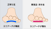通勤やランニングで痛む親指。原因は色々だが、元は靴にある。