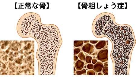 骨粗しょう症