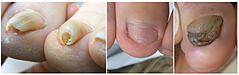 巻き爪の種類と症状について（陥入爪、湾曲爪、爪甲鉤弯症）