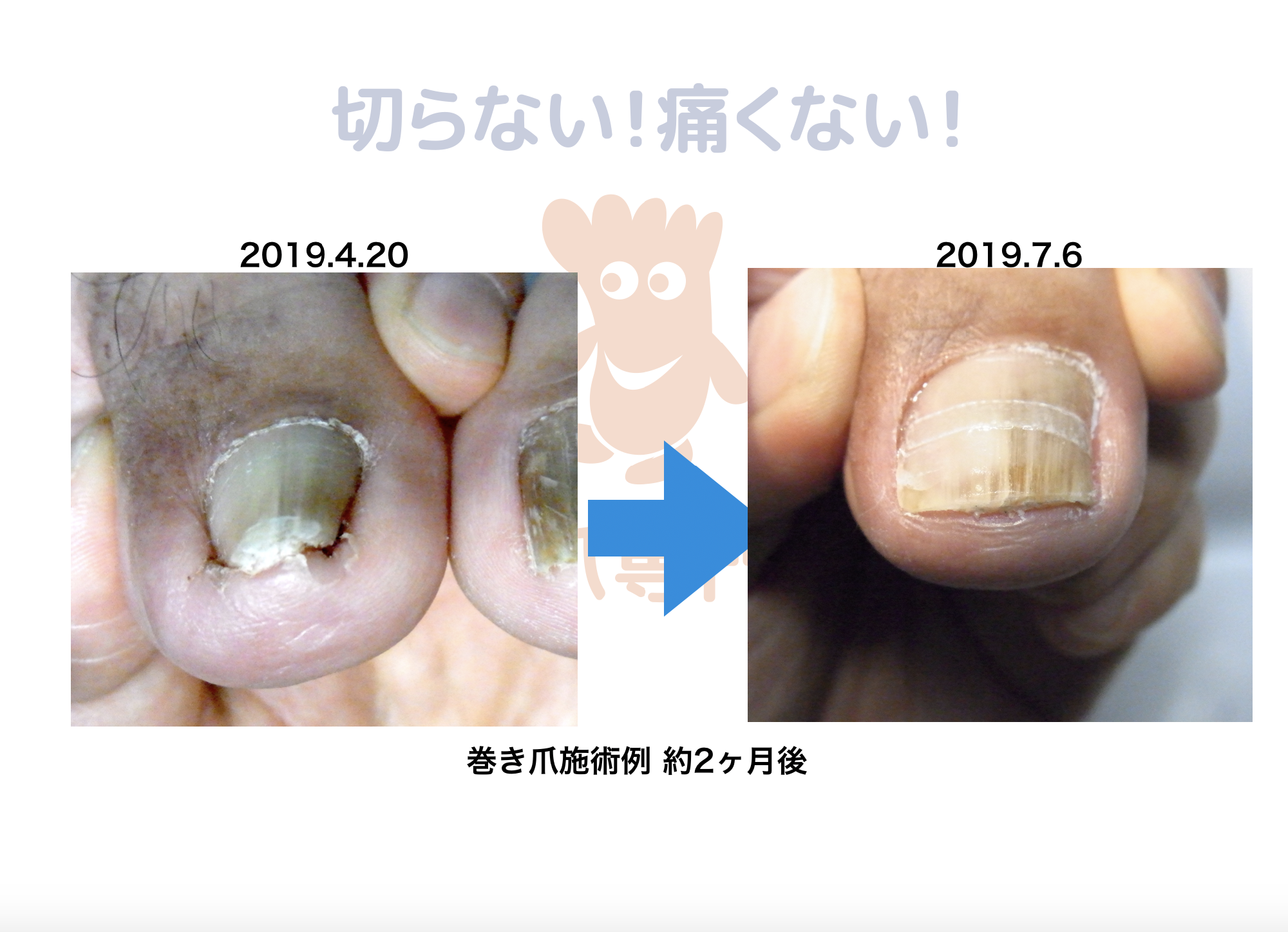 食い込む爪を自分で切って処置し悪化した巻き爪も！