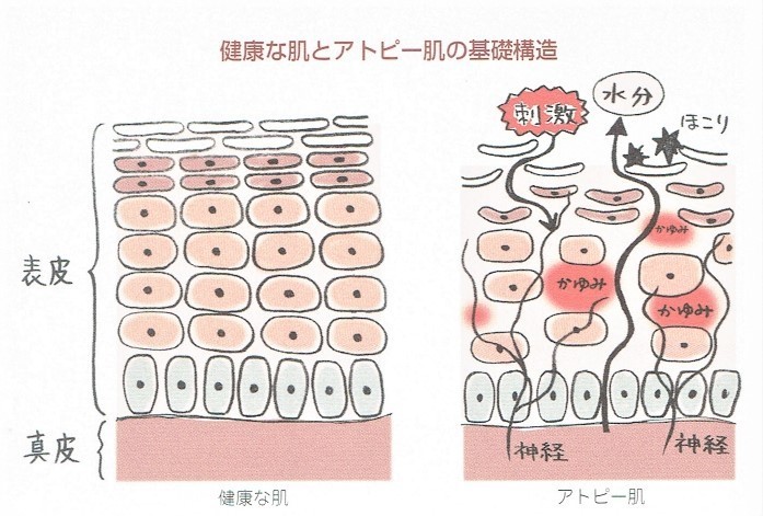 健康な肌とアトピー肌の基礎構造