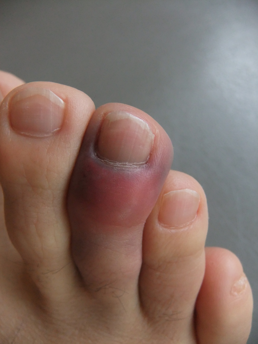 足の指先 腫れ 足の指の腫れは何が原因 痛む場所で予測する内臓疾患