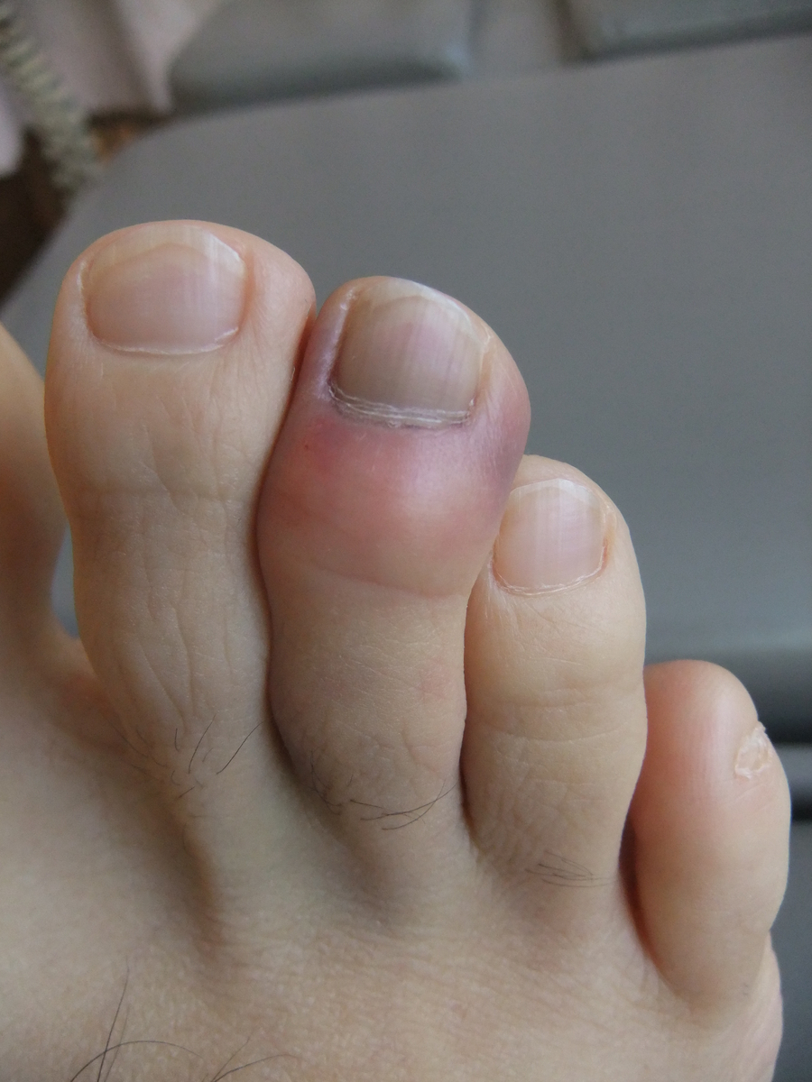 ぶつけ た の 指 内出血 足 足の指をぶつけて痛い！内出血している！足の指の骨は折れやすい。放っておかずに早目に治療しましょう！