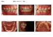開咬患者を歯科矯正装置で治療した1例　