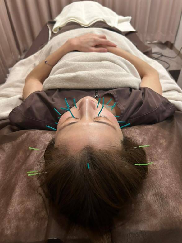美容鍼も行います