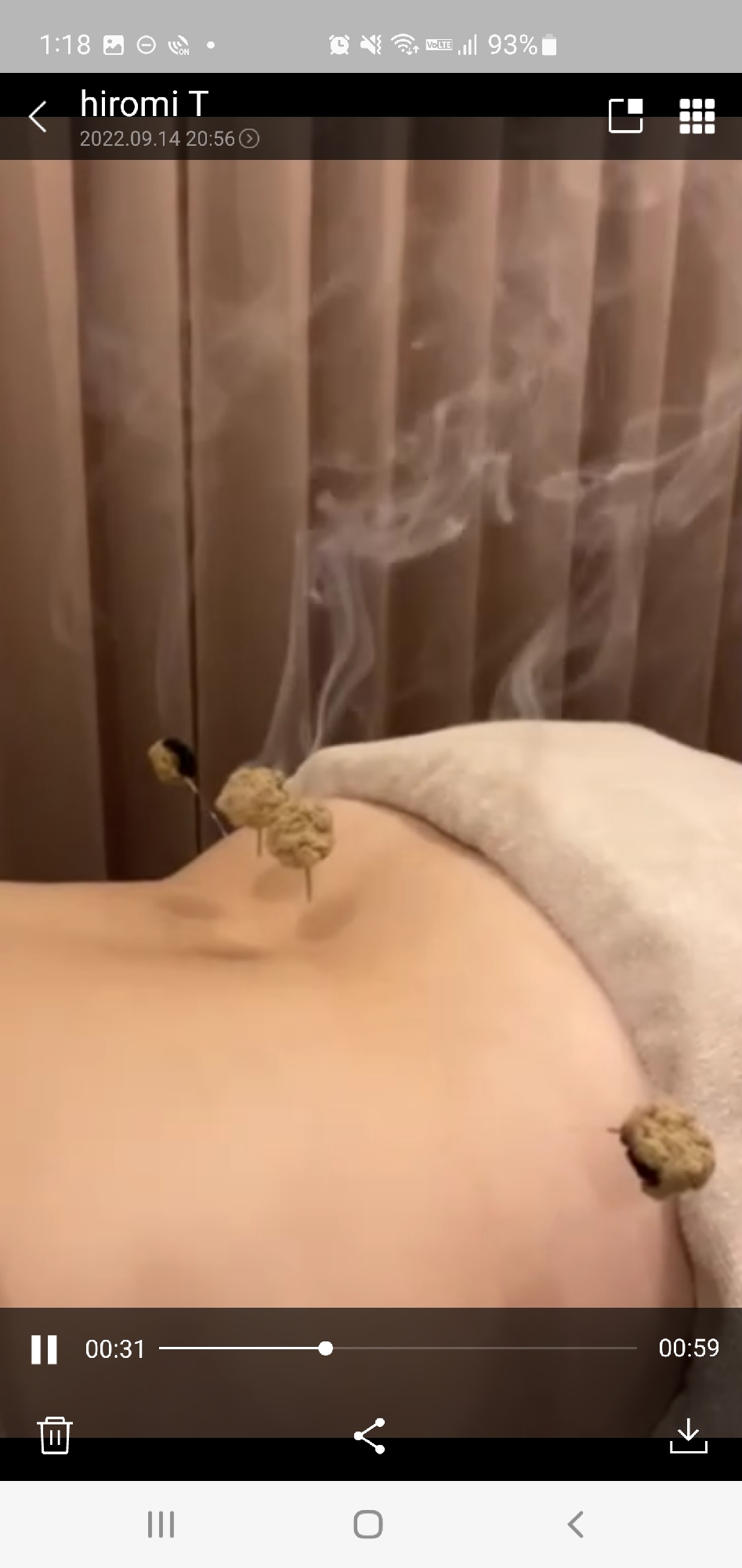 灸頭鍼で鍼とお灸のダブル効果