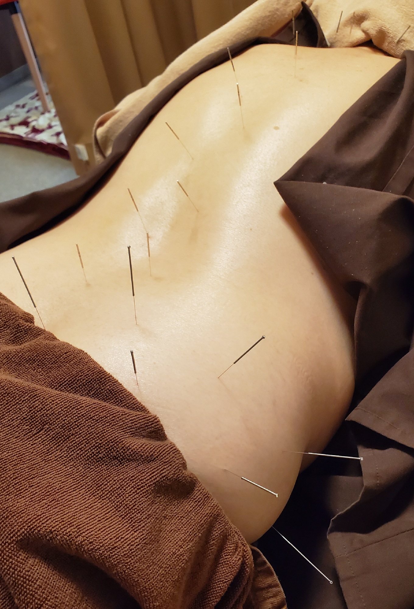 腰痛に対応した鍼