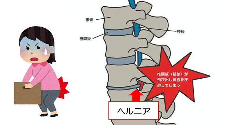 ヘルニアとの違い