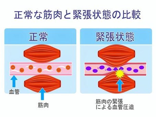 筋肉の緊張